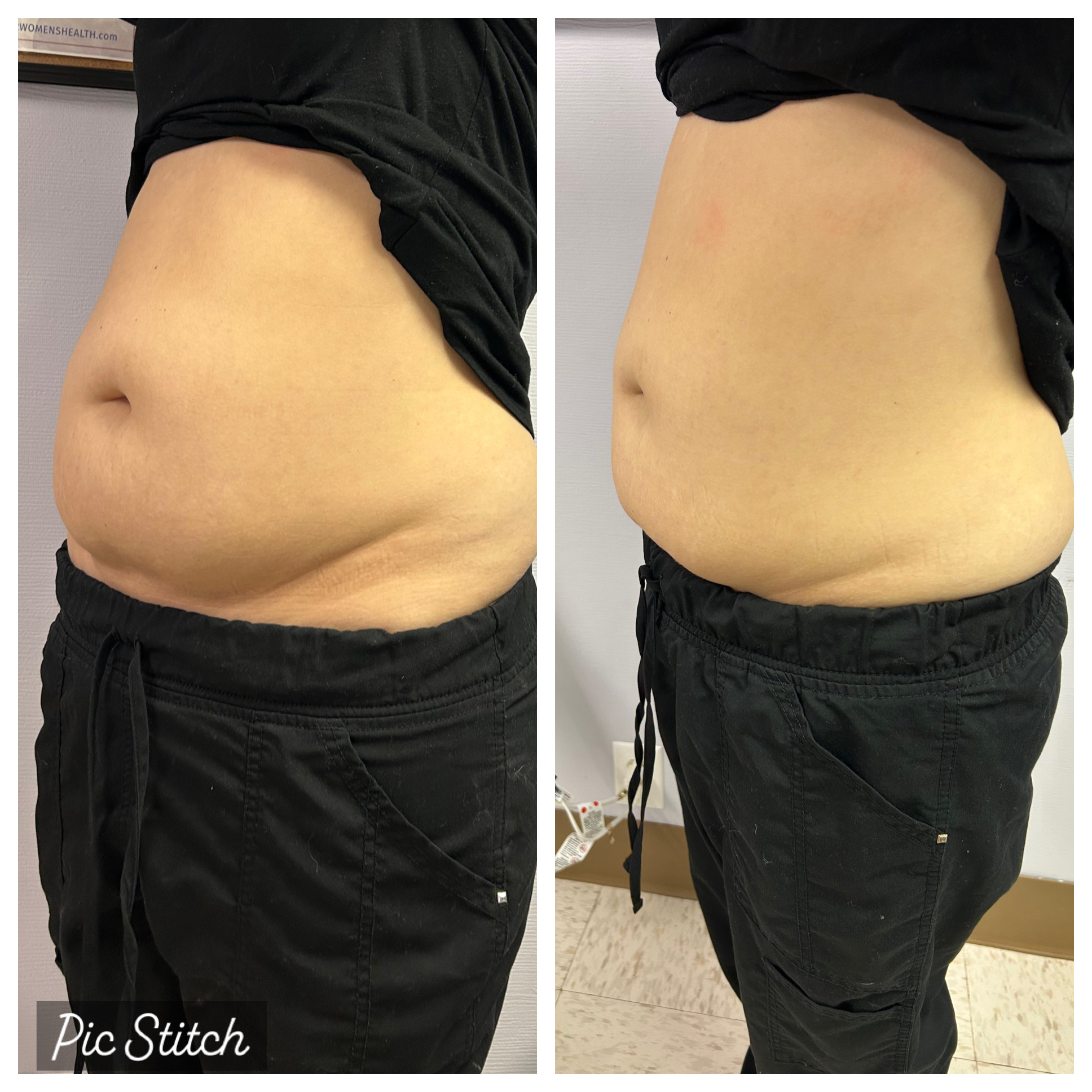 Before after photo of fat reduction and skin tightening results