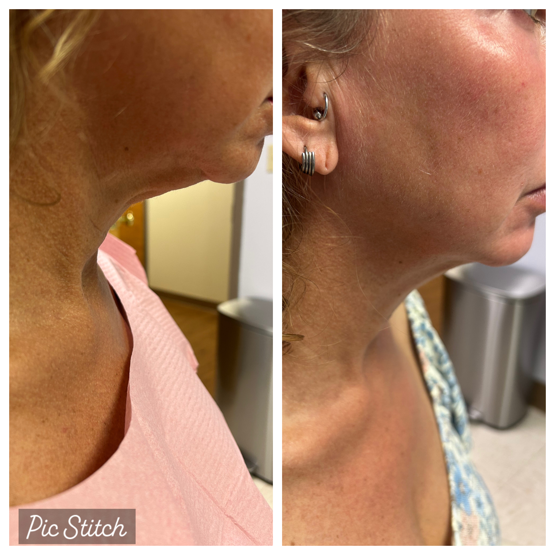 Before after photo of fat reduction and skin tightening results