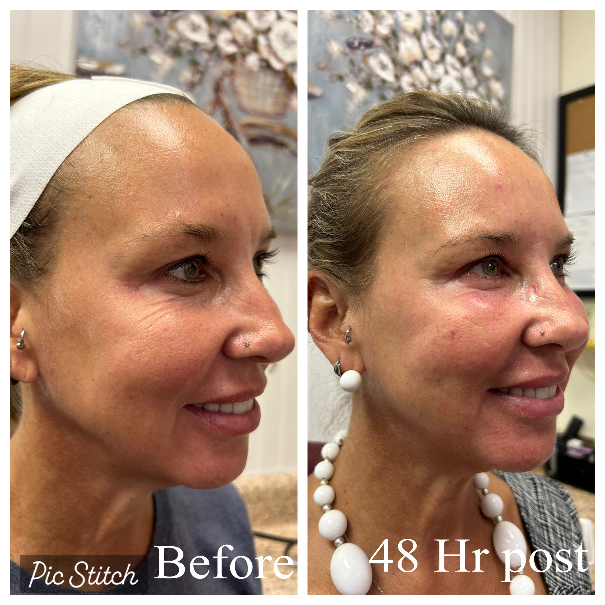 Berfore / After photo of fat reduction and skin tightening results