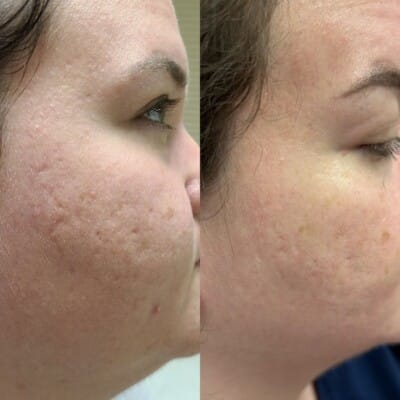 Morephus-Acne-Scar-Treatment-Before-After-Skin-Transformation-400×400 Before and after images of Morpheus8 treatment to remove acne scars.