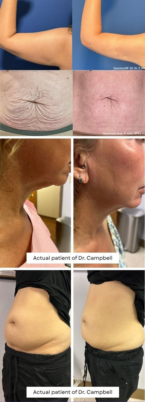 Quntum Treatment Areas Berfore / After photo of fat reduction and skin tightening results