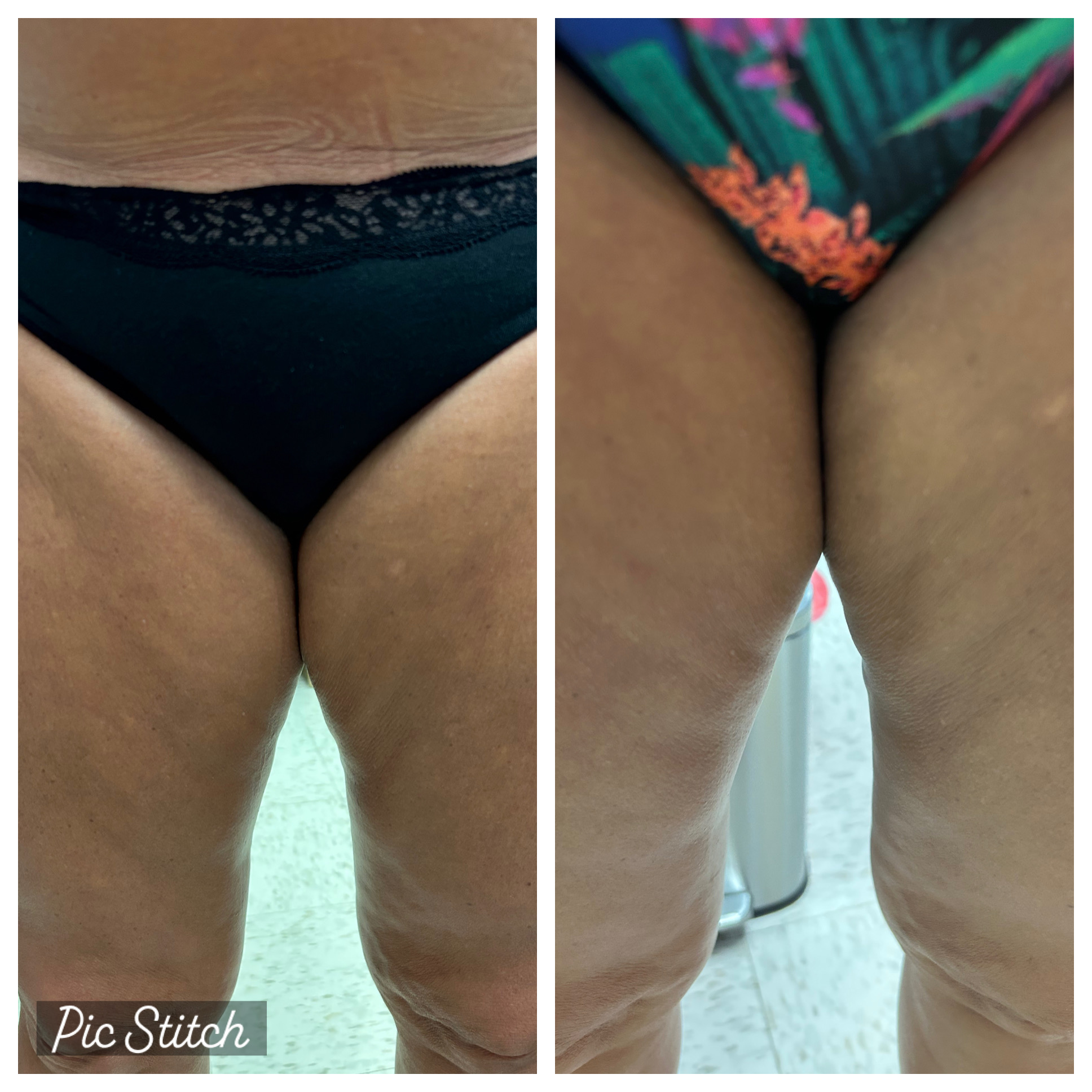Berfore / After photo of fat reduction and skin tightening results